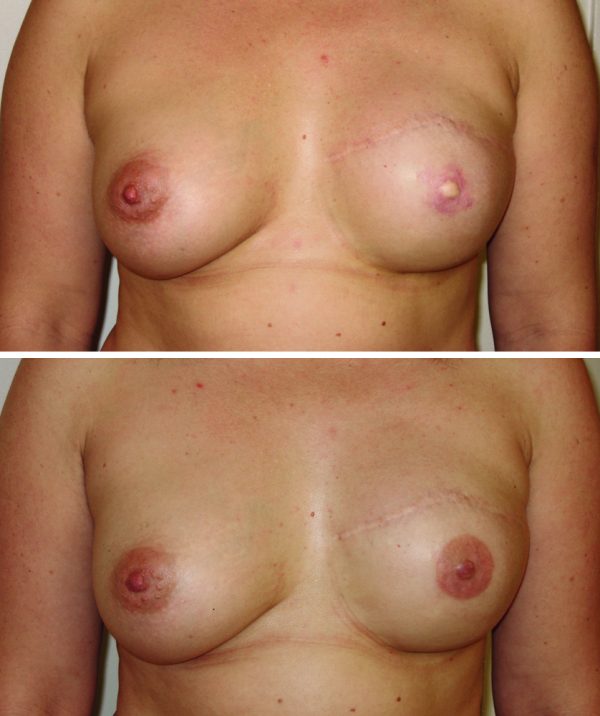Une fois la prothèse mammaire posée et le mamelon reconstruit, Rosina Fleury a pu procéder à l'intervention de pigmentation. Voici le résultat un mois après.